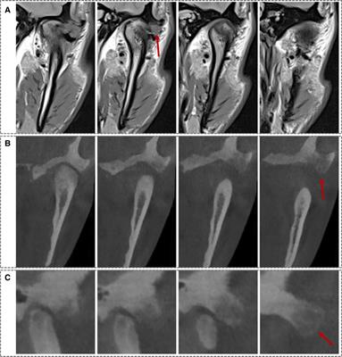 Temporal bone osteoblastoma involving temporomandibular joint diagnosed as simple disc disorders: A case report